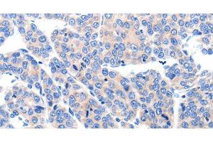 Immunohistochemistry of paraffin-embedded Human ovarian cancer tissue using KCNH8 Polyclonal Antibody at dilution 1:50 (KCNH8 Antikörper)