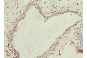 Immunohistochemistry of paraffin-embedded human breast cancer using ABIN7167073 at dilution of 1:100 (HBXIP Antikörper  (AA 1-91))