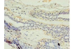 Immunohistochemistry of paraffin-embedded human breast cancer using ABIN7154147 at dilution of 1:100 (GK2 Antikörper  (AA 2-553))