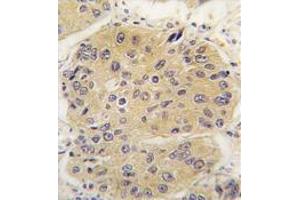 Formalin-Fixed, Paraffin-Eembedded Human lung carcinoma tissue stained with EIF4A1 Antibody (N-term),which was peroxidase-conjugated to the secondary antibody, followed by DAB staining. (EIF4A1 Antikörper  (N-Term))