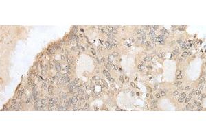Immunohistochemistry of paraffin-embedded Human colorectal cancer tissue using ZZZ3 Polyclonal Antibody at dilution of 1:50(x200) (ZZZ3 Antikörper)