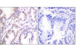 Immunohistochemistry analysis of paraffin-embedded human lung carcinoma tissue using CDK7 antibody. (CDK7 Antikörper  (C-Term))