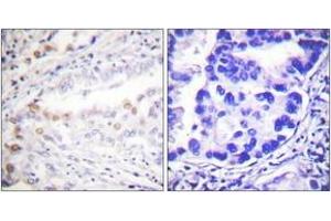 Immunohistochemistry analysis of paraffin-embedded human lung carcinoma tissue, using Uba2 Antibody.