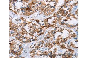 Immunohistochemistry of Human cervical cancer using HINT2 Polyclonal Antibody at dilution of 1:40 (HINT2 Antikörper)