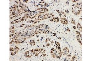 IHC-P: MCM2 antibody testing of human lung cancer tissue (MCM2 Antikörper  (C-Term))