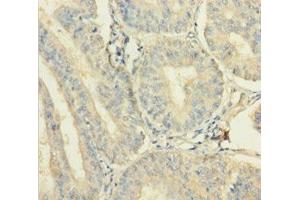 Immunohistochemistry of paraffin-embedded human endometrial cancer using ABIN7175017 at dilution of 1:100 (C12orf49 Antikörper  (AA 34-205))