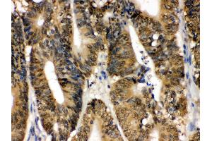 IHC(P): Human Intestinal Cancer Tissue