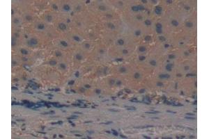DAB staining on IHC-P; Samples: Human Liver cancer Tissue (ADAMTS5 Antikörper  (AA 485-622))