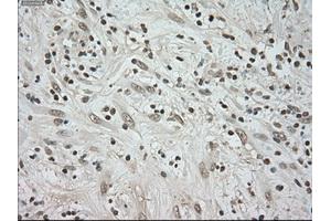 Immunohistochemical staining of paraffin-embedded Carcinoma of kidney tissue using anti-BUB1Bmouse monoclonal antibody. (BUB1B Antikörper)
