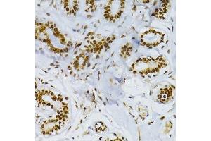 Immunohistochemistry of paraffin-embedded human breast cancer using SNRNP70 antibody. (SNRNP70 Antikörper  (AA 150-250))