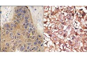 (LEFT)Formalin-fixed and paraffin-embedded human hepatocarcinoma tissue reacted with CHIP (STUB1) antibody (C-term), which was peroxidase-conjugated to the secondary antibody, followed by DAB staining. (STUB1 Antikörper  (C-Term))