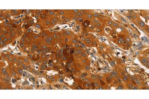 Immunohistochemistry of paraffin-embedded Human lung cancer using ORM2 Polyclonal Antibody at dilution of 1:40
