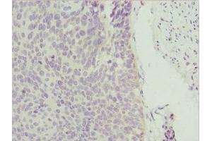 Immunohistochemistry of paraffin-embedded human cervical cancer using ABIN7176006 at dilution of 1:100 (ZNF187 Antikörper  (AA 239-478))