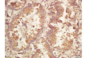 Formalin-fixed and paraffin embedded human lung carcinoma labeled with Rabbit Anti-Caspase-9 (Ser196) Polyclonal Antibody, Unconjugated (ABIN756922) at 1:200 followed by conjugation to the secondary antibody and DAB staining (Caspase 9 Antikörper  (pSer196))