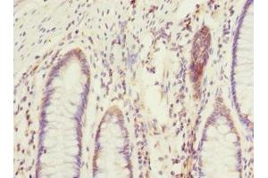 Immunohistochemistry of paraffin-embedded human colon cancer using ABIN7172903 at dilution of 1:100 (EIF2B2 Antikörper  (AA 1-351))