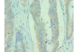 Immunohistochemistry of paraffin-embedded human colon cancer using ABIN7159681 at dilution of 1:100 (MICA Antikörper  (AA 24-307))