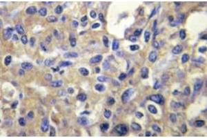 Immunohistochemistry (IHC) analyzes of MELK antibody in paraffin-embedded human liver carcinoma tissue. (MELK Antikörper)