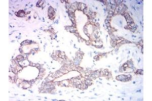 Immunohistochemical analysis of paraffin-embedded stomach cancer tissues using KRT19 mouse mAb with DAB staining.