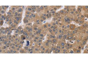 Immunohistochemistry of paraffin-embedded Human liver cancer using SDCCAG3 Polyclonal Antibody at dilution of 1:30 (SDCCAG3 Antikörper)