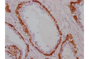 IHC image of ABIN7180960 diluted at 1:100 and staining in paraffin-embedded human prostate cancer performed on a Leica BondTM system. (KRT17 Antikörper)