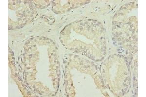 Immunohistochemistry of paraffin-embedded human prostate cancer using ABIN7153936 at dilution of 1:100 (GID8/C20orf11 Antikörper  (AA 1-228))