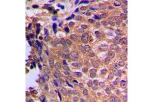 Immunohistochemical analysis of Cofilin staining in human breast cancer formalin fixed paraffin embedded tissue section. (Cofilin Antikörper  (N-Term))