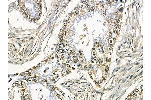 ZIP7 Mouse Monoclonal Antibody at 1/100 staining human pancreatic cancer by IHC-P. (SLC39A7 Antikörper)