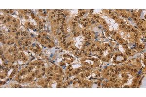Immunohistochemistry of paraffin-embedded Human thyroid cancer using CEL Polyclonal Antibody at dilution of 1:40 (Cholesterol Esterase Antikörper)