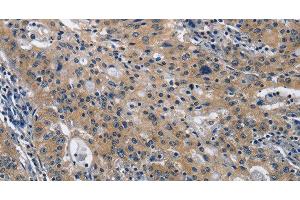 Immunohistochemistry of paraffin-embedded Human gastric cancer using CD160 Polyclonal Antibody at dilution of 1:30 (CD160 Antikörper)