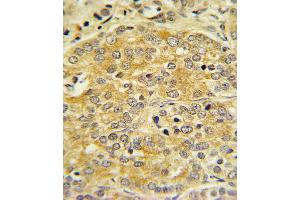 OL1 Antibody (C-term) 7361b IHC analysis in formalin fixed and paraffin embedded human Prostate carcinoma followed by peroxidase conjugation of the secondary antibody and DAB staining. (APOL1 Antikörper  (C-Term))