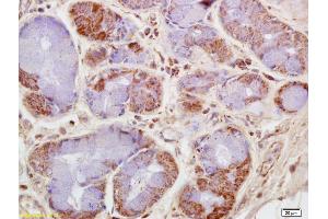 Formalin-fixed and paraffin embedded human lung carcinoma labeled with Rabbit Anti CKMT/Creatine kinase MT Polyclonal Antibody, Unconjugated (ABIN717536) at 1:200 followed by conjugation to the secondary antibody and DAB staining (CKMT1B Antikörper  (AA 115-220))