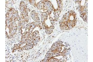 IHC-P Image Immunohistochemical analysis of paraffin-embedded OVCA xenograft, using DCI, antibody at 1:100 dilution. (DCI Antikörper)
