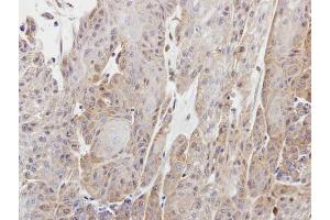 IHC-P Image Immunohistochemical analysis of paraffin-embedded Cal27 xenograft, using Copine I, antibody at 1:100 dilution. (CPNE1 Antikörper)
