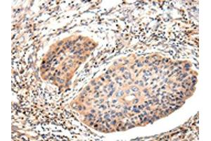 The image on the left is immunohistochemistry of paraffin-embedded Human esophagus cancer tissue using ABIN7191260(Lambda Light chain Antibody) at dilution 1/20, on the right is treated with synthetic peptide. (IGLV1-51 Antikörper)