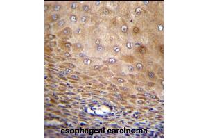 TMEM43 Antibody (Center) (ABIN656549 and ABIN2845811) immunohistochemistry analysis in formalin fixed and paraffin embedded human esophageal carcinoma followed by peroxidase conjugation of the secondary antibody and DAB staining. (TMEM43 Antikörper  (AA 195-223))