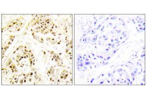 Immunohistochemistry analysis of paraffin-embedded human breast carcinoma tissue using FEN1 antibody. (FEN1 Antikörper  (Internal Region))