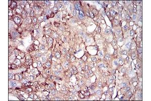 Immunohistochemical analysis of paraffin-embedded liver cancer tissues using FTL mouse mAb with DAB staining. (FTL Antikörper  (full length))
