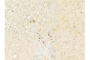 ABIN6261540 and ABIN6272998 at 1/100 staining human hepatocellular carcinoma by IHC-P. (ENOX2 Antikörper  (N-Term))