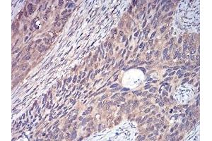 Immunohistochemical analysis of paraffin-embedded human cervical cancer tissues using YWHAB mouse mAb with DAB staining.