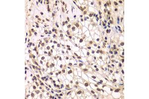Immunohistochemistry of paraffin-embedded human kidney cancer using SMARCC1 antibody. (SMARCC1 Antikörper  (AA 80-320))