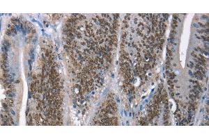 Immunohistochemistry of paraffin-embedded Human colon cancer tissue using GNRH1 Polyclonal Antibody at dilution 1:65 (GNRH1 Antikörper)