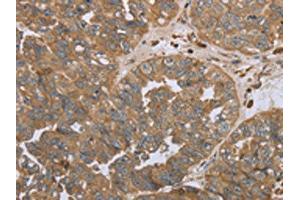 The image on the left is immunohistochemistry of paraffin-embedded Human ovarian cancer tissue using ABIN7191695(NPR2 Antibody) at dilution 1/45, on the right is treated with synthetic peptide. (NPR2 Antikörper)