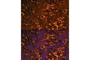 Immunofluorescence analysis of Human liver cancer using UGT1 antibody (ABIN6132769, ABIN6149895, ABIN6149896 and ABIN6221779) at dilution of 1:100. (UGT1A1 Antikörper  (AA 1-200))