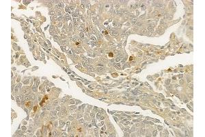 ABIN6257971 and ABIN6273840 at 1/100 staining human lung squamous cell carcinoma by IHC-P. (CCR1 Antikörper  (N-Term))