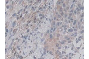 Detection of RALA in Human Lung cancer Tissue using Monoclonal Antibody to V-Ral Simian Leukemia Viral Oncogene Homolog A (RALA) (rala Antikörper  (AA 1-206))