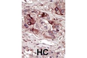 Formalin-fixed and paraffin-embedded human cancer tissue reacted with the primary antibody, which was peroxidase-conjugated to the secondary antibody, followed by DAB staining. (PHKG2 Antikörper  (AA 304-334))