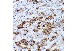 Immunohistochemistry of paraffin-embedded human colon carcinoma using TFF3 Rabbit mAb (ABIN1680916, ABIN3019077, ABIN3019078 and ABIN7101711) at dilution of 1:100 (40x lens).