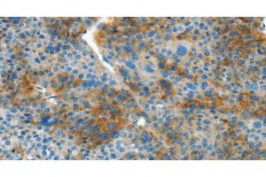 Immunohistochemistry of paraffin-embedded Human liver cancer tissue using L1CAM Polyclonal Antibody at dilution 1:40 (L1CAM Antikörper)