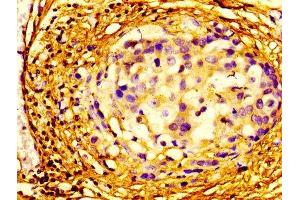 Immunohistochemistry of paraffin-embedded human breast cancer using ABIN7152106 at dilution of 1:100 (EIF4A2 Antikörper  (AA 1-407))