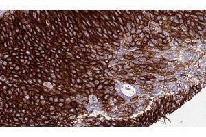 ABIN6276511 at 1/100 staining Human urothelial cancer tissue by IHC-P. (Nicastrin Antikörper  (C-Term))